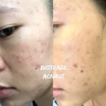 Hình ảnh Thực Tế Review Combo Giảm Mụn Viêm Mủ Biotrade Acnaut - 1Shop.com.vn